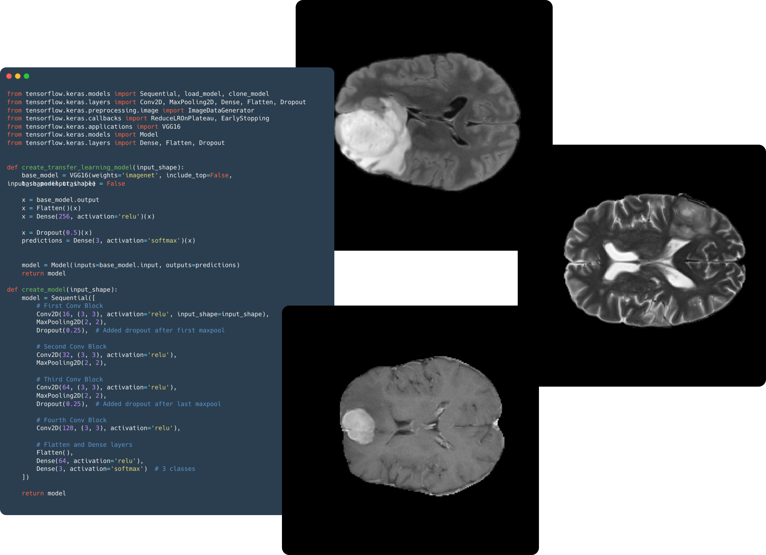 XAI for Brain MRI Glioblastoma Diagnosis